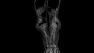 포옹하고 있는 두 남녀의 X-레이 사진